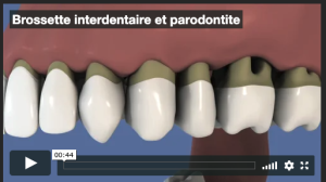 Brossette interdentaire et parodontite